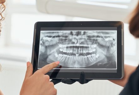 Types of Dental X-rays