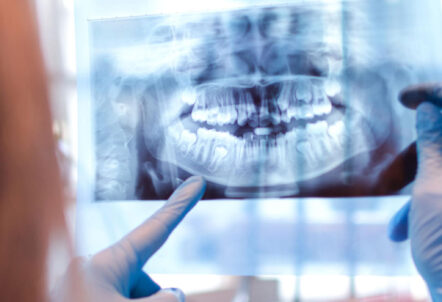Types of Dental X-rays