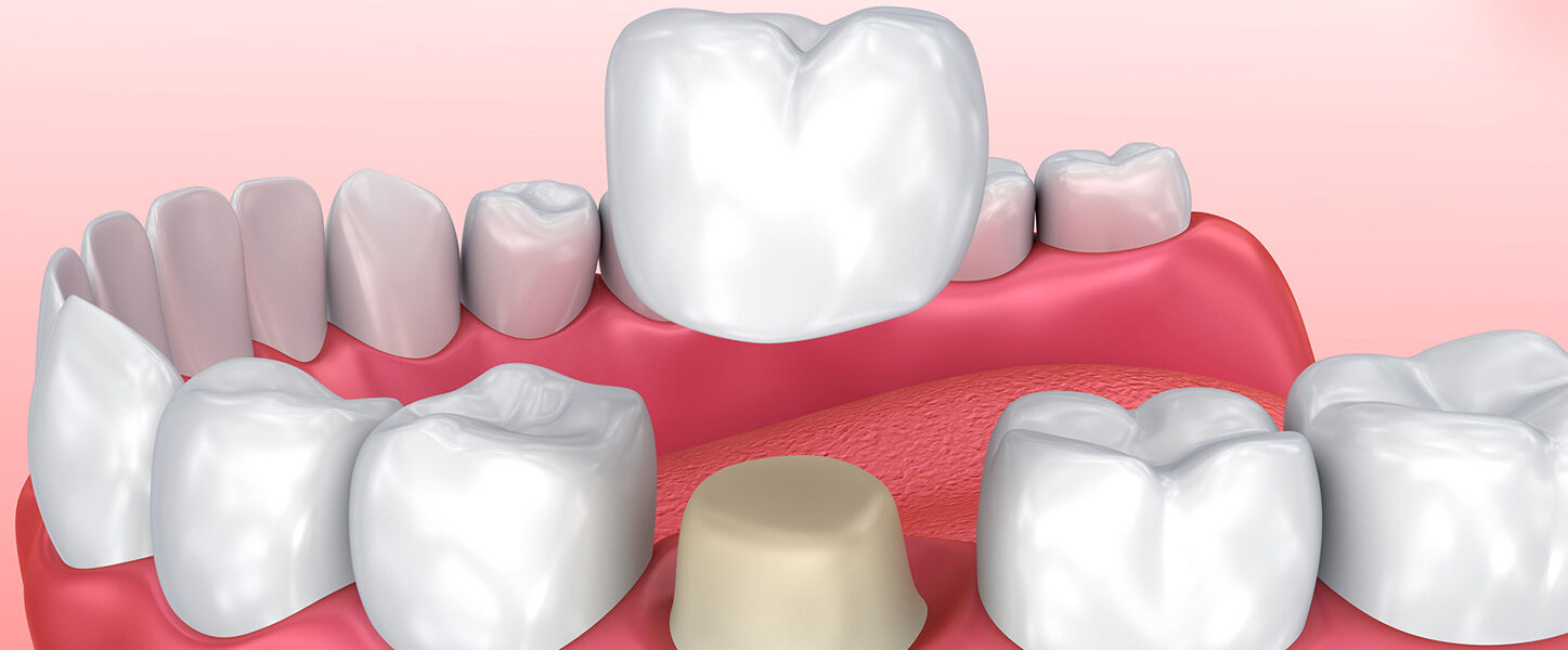 How Do Dental Crowns Work?