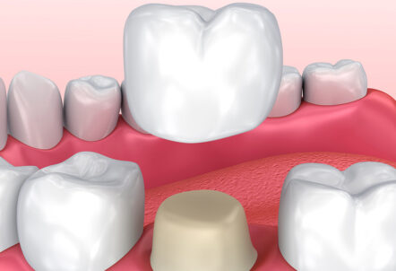 How Do Dental Crowns Work?