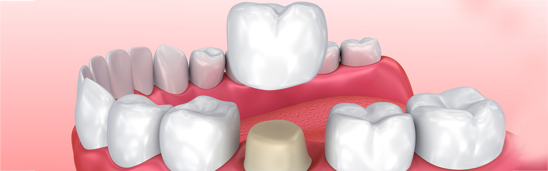 How Do Dental Crowns Work?