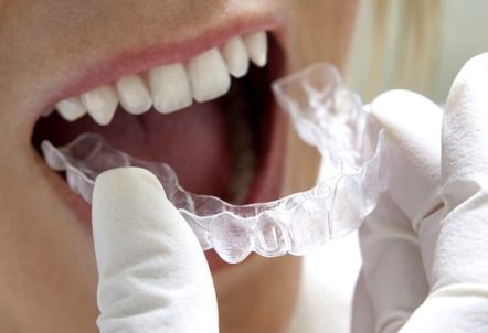 Invisalign® -- A Simple Treatment That Can Change Your Look 