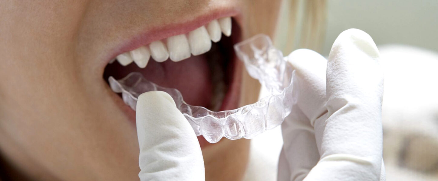 An Overview of Invisalign®