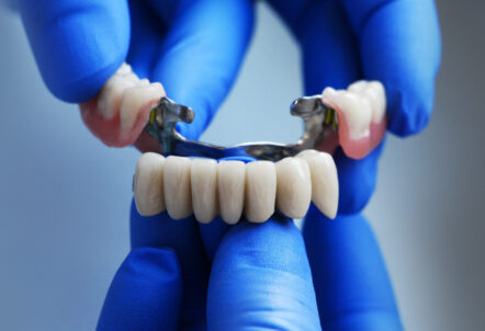 The Beginner’s Guide to Dental Bridges: All You Need to Know	