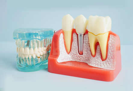 What is the Most Common Problem With Dental Implants?