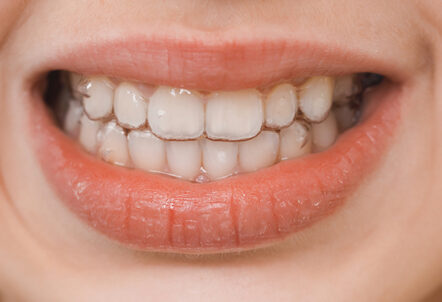 What Is ICON White Spot Treatment and How Does It Work? 