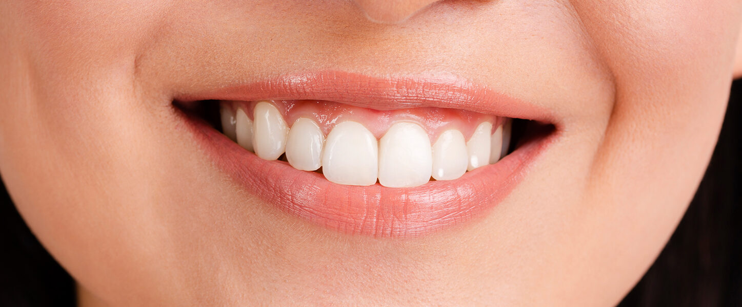 How ICON White Spot Treatment Restores Your Smile