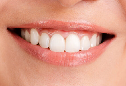 How ICON White Spot Treatment Restores Your Smile