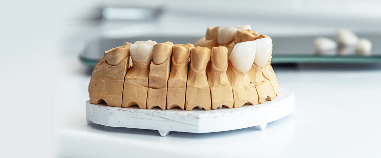 5 Signs You Might Need Dental Veneers