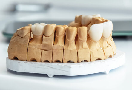 5 Signs You Might Need Dental Veneers