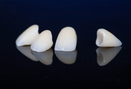 Understanding Dental Crowns