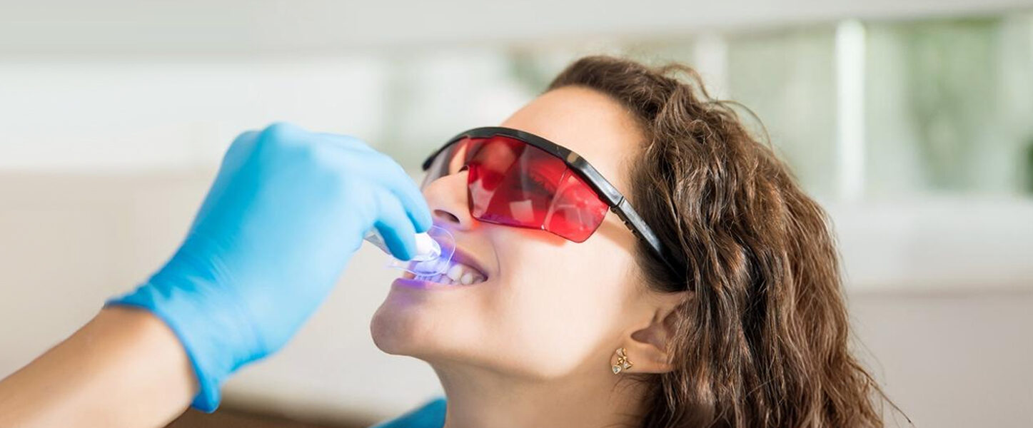 ICON vs. Traditional Whitening: Which Is Better for White Spots in Dallas?